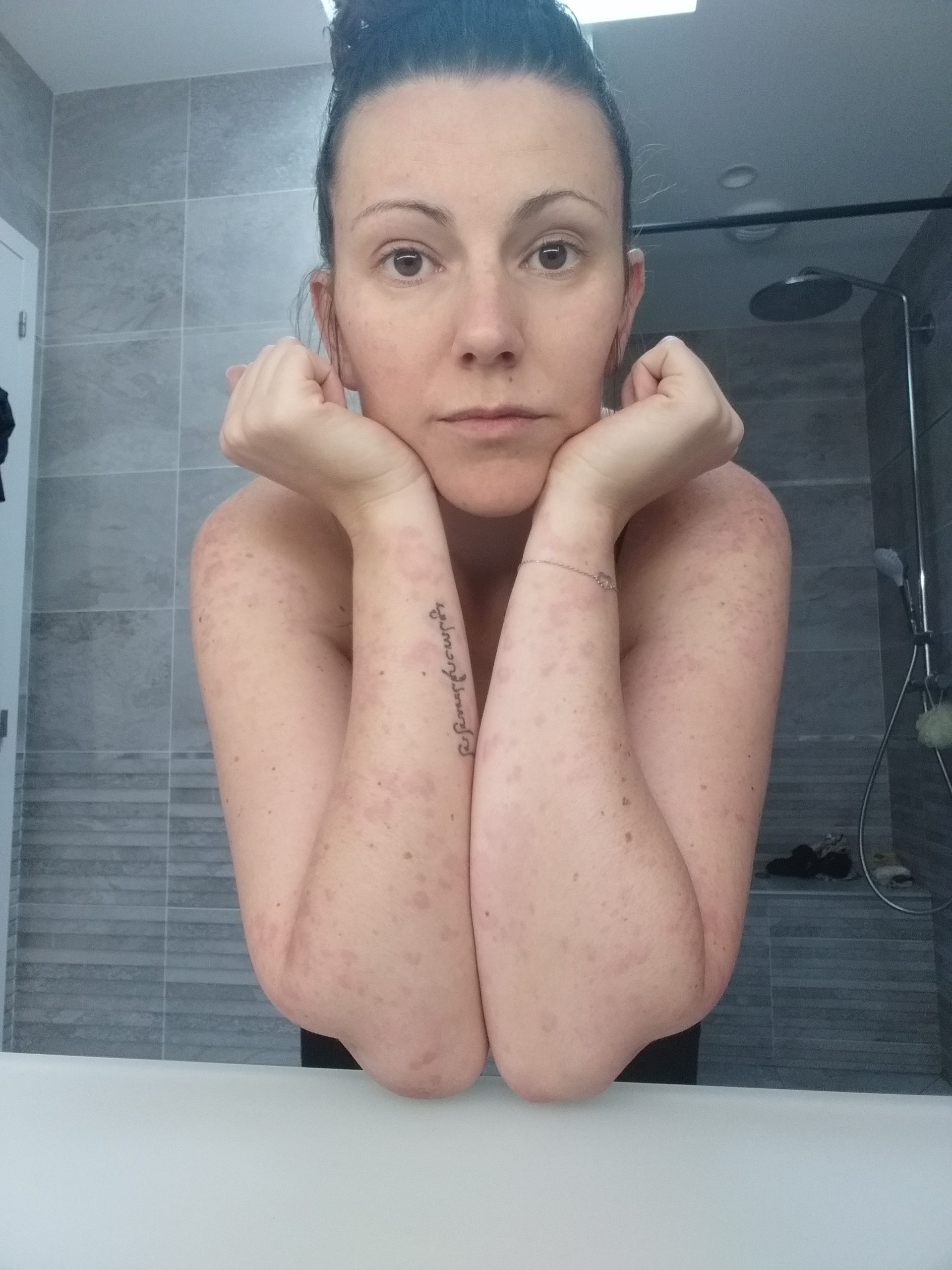 photo de Gaëlle montrant des plaques rouge sur ses bras